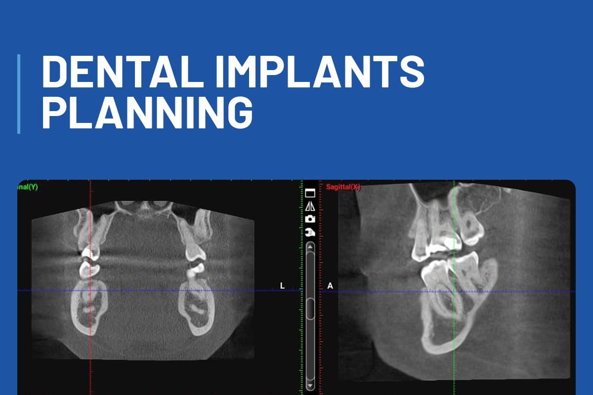 Dental Implants Planning