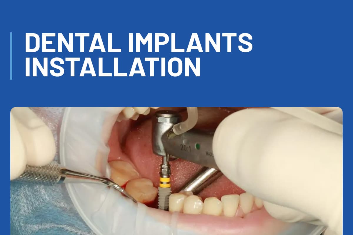 Dental Implants Installation + Live Demo