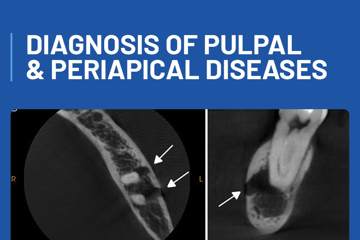 Diagnosis of Pulpal & Periapical Diseases