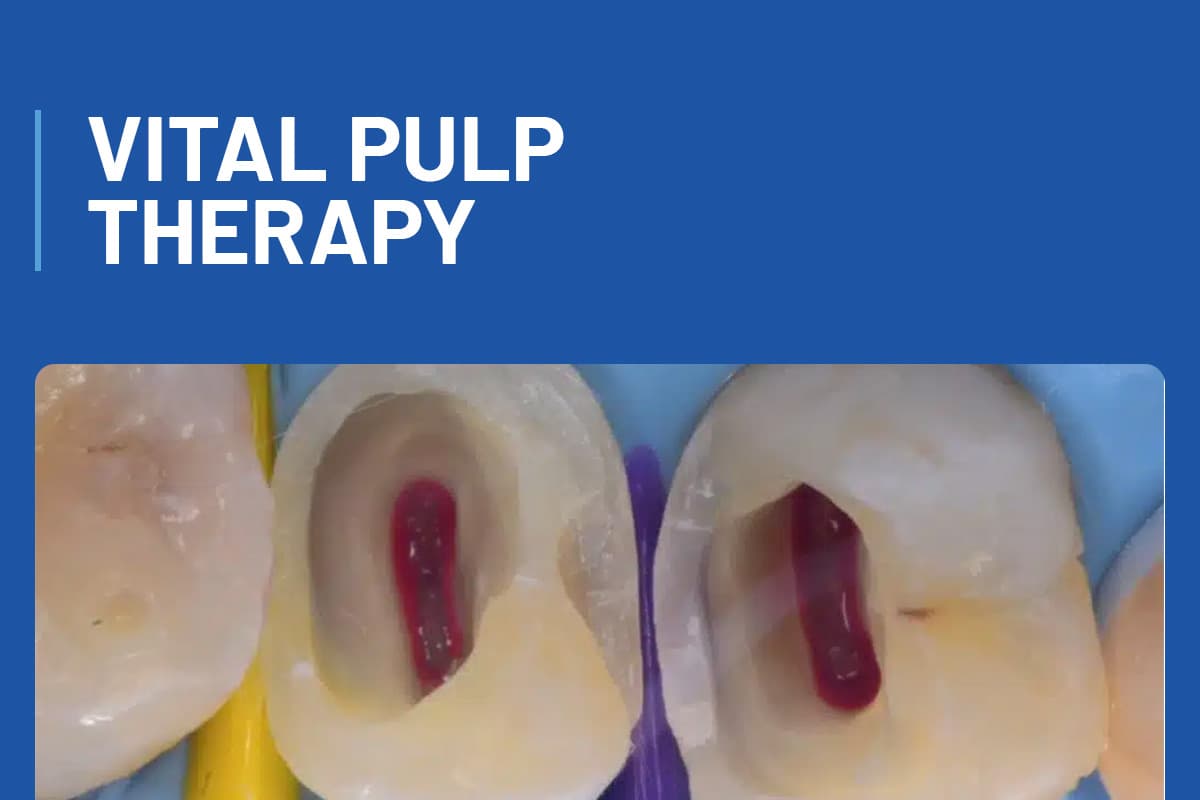Vital Pulp Therapy