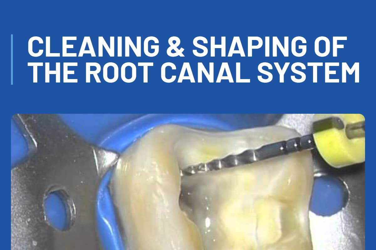 Cleaning & Shaping of the Root Canal System