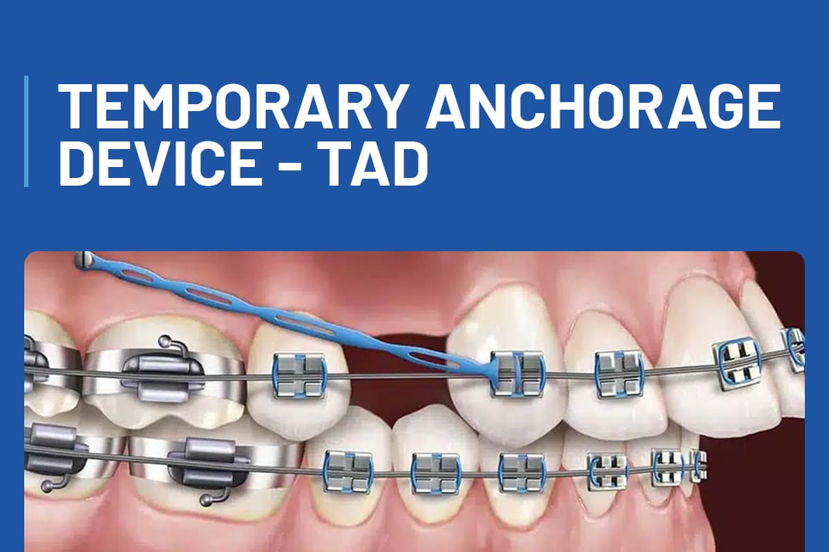 Temporary Anchorage Device - TAD