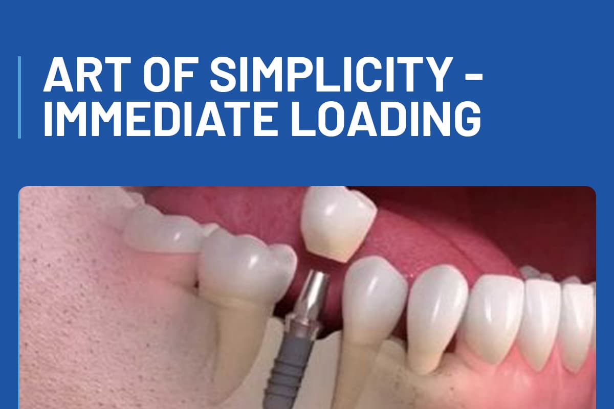 Art of Simplicity - Immediate Loading