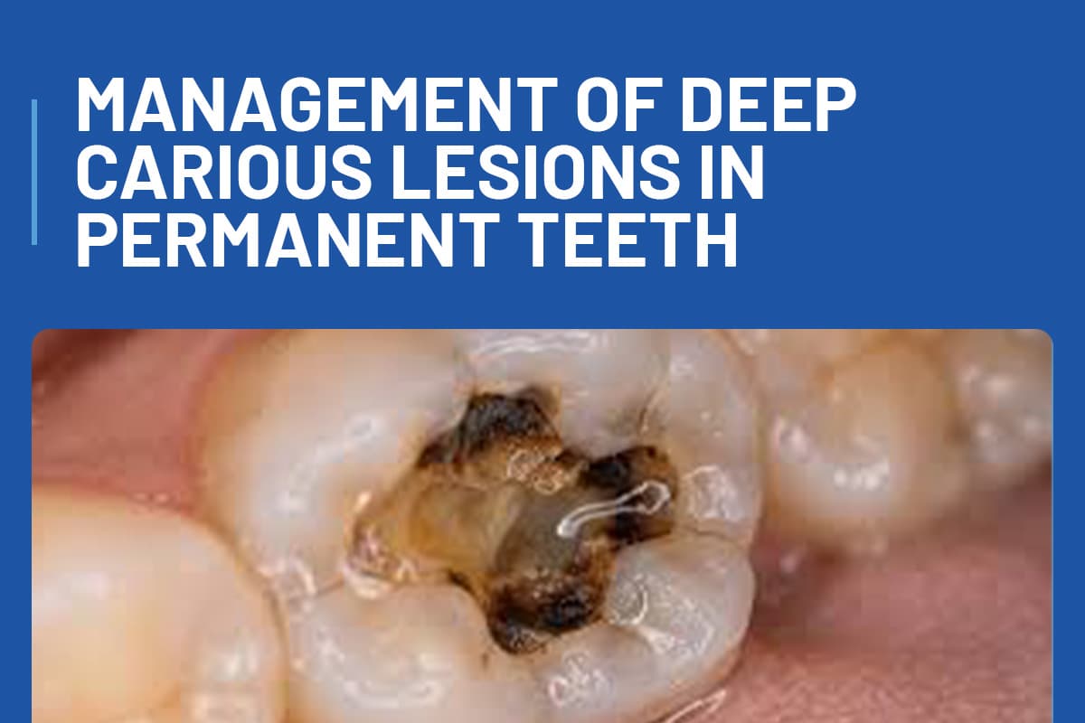 Management of Deep Carious Lesions in Permanent Teeth