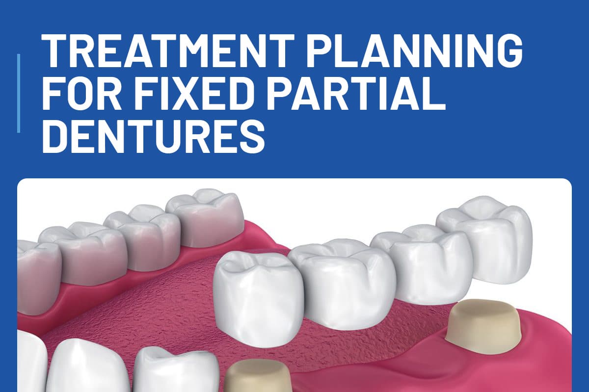 Treatment Planning for Fixed Partial Dentures