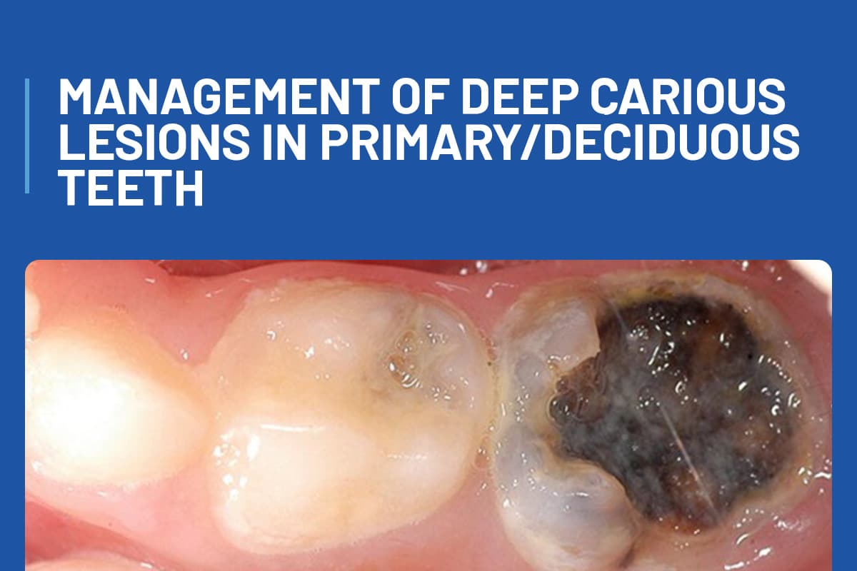 Management of Deep Carious Lesions in Primary/Deciduous Teet
