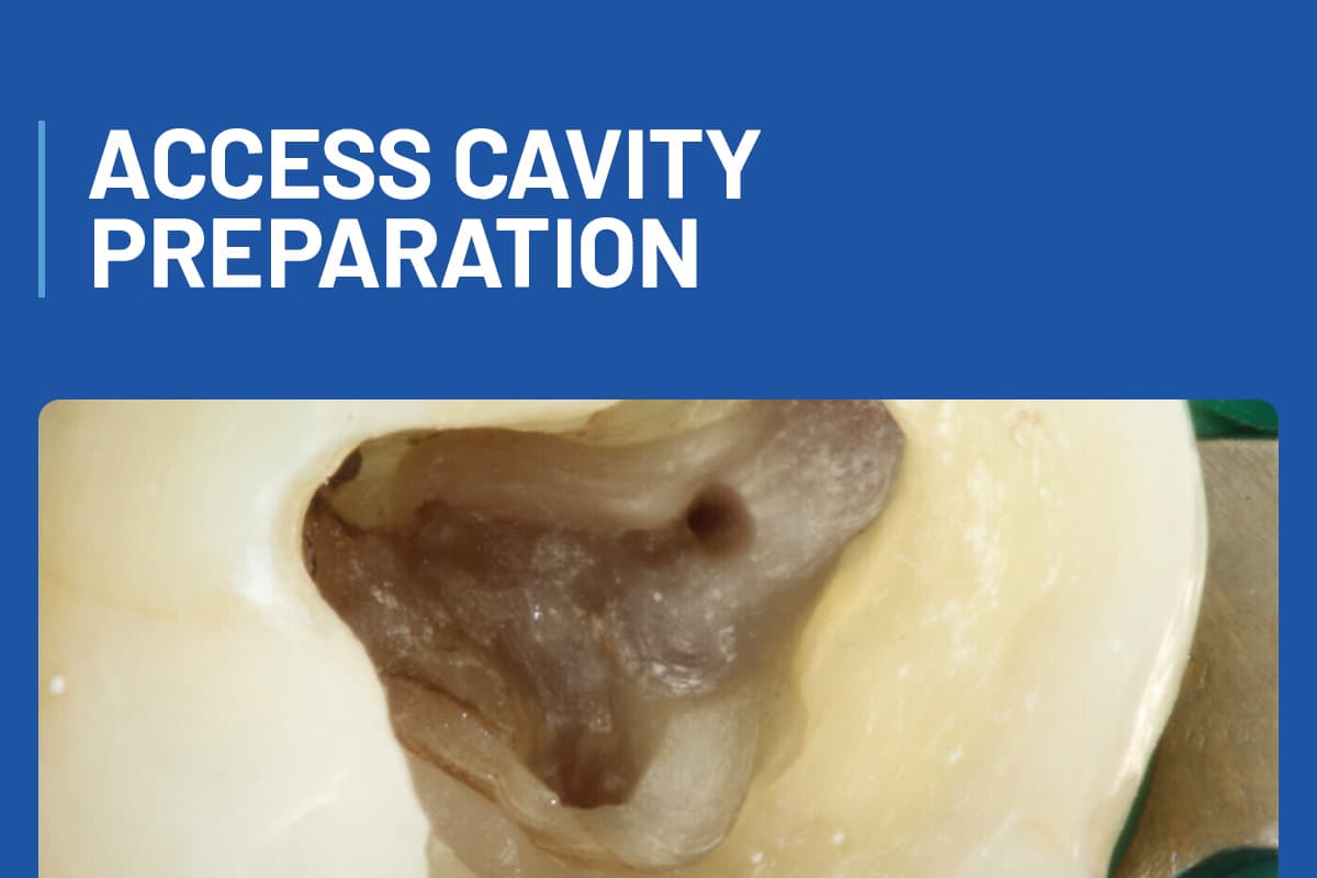 Access Cavity Preparation