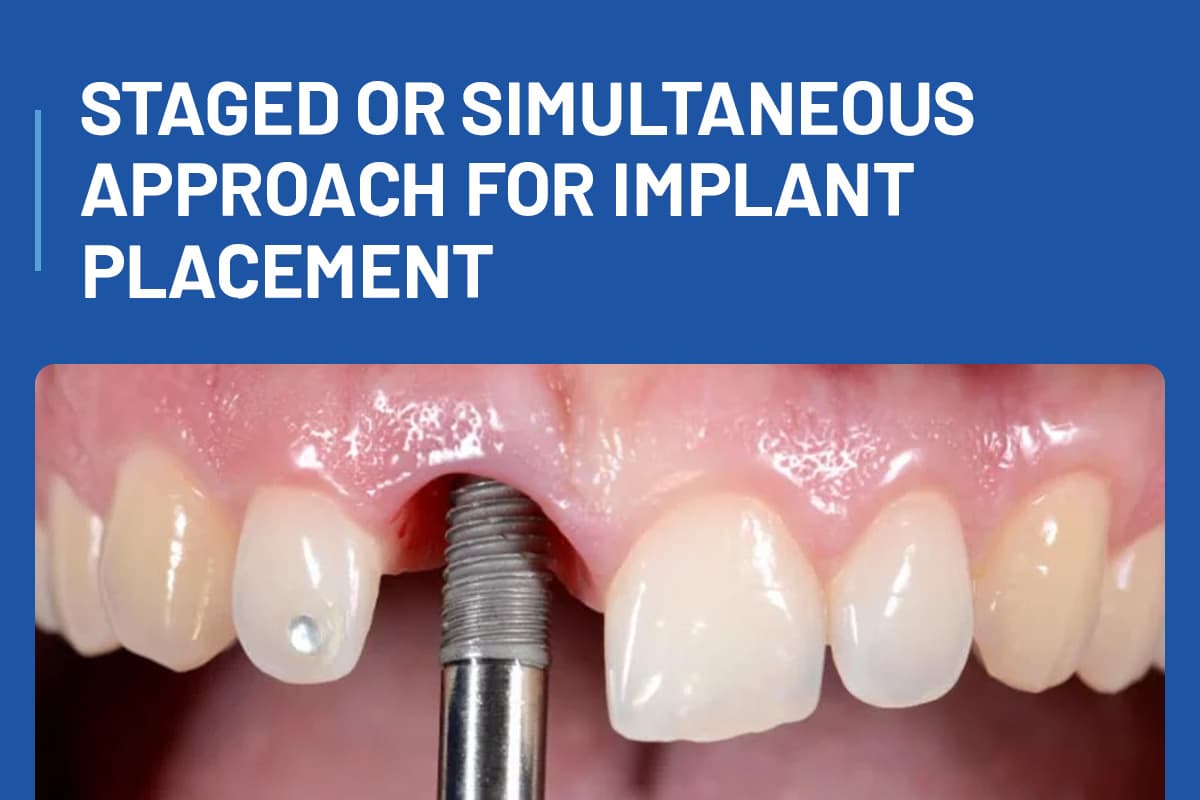 Staged or Simultaneous Approach for Implant Placement