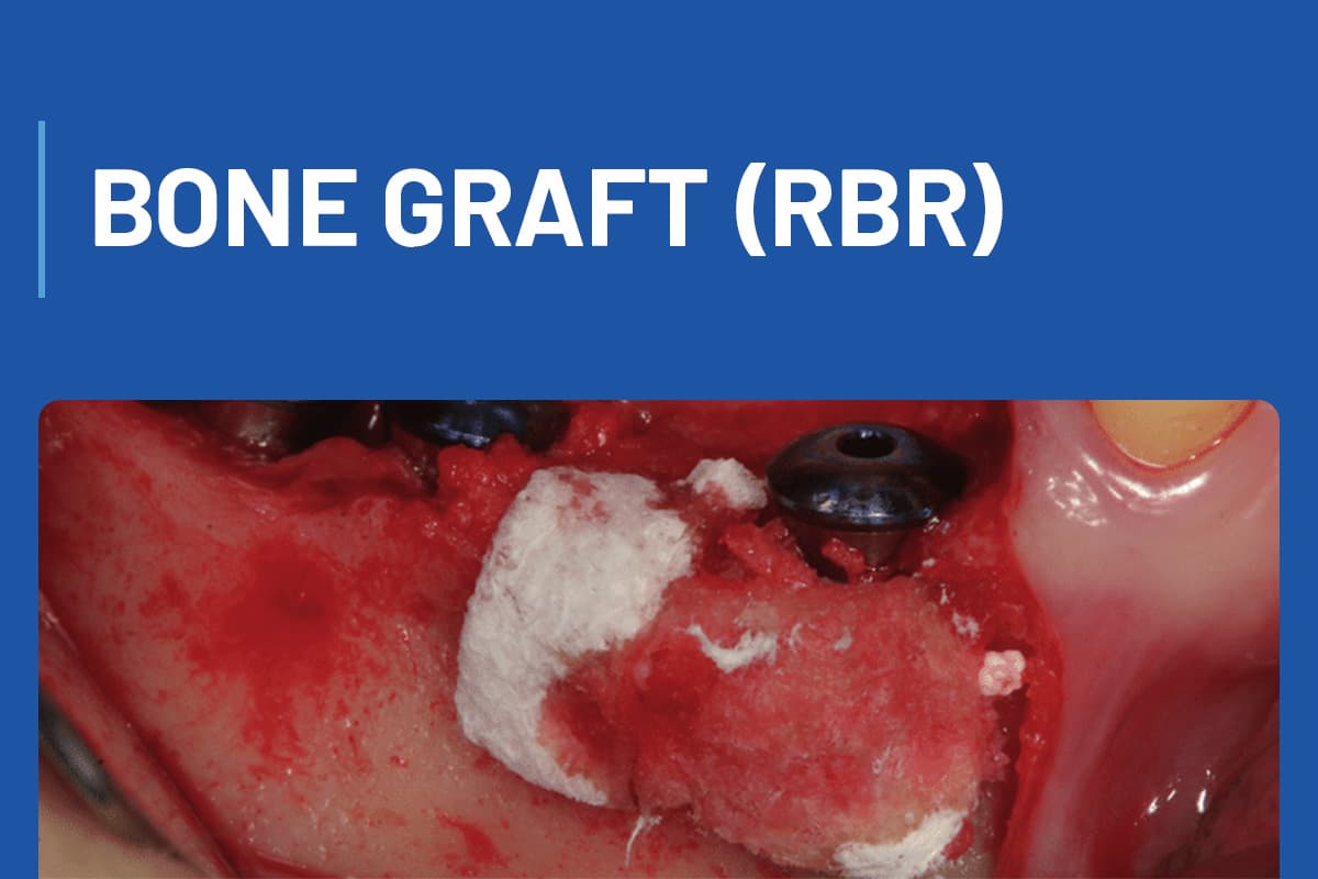 Bone Graft (RBR)
