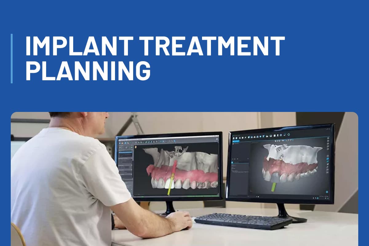 Implant Treatment Planning